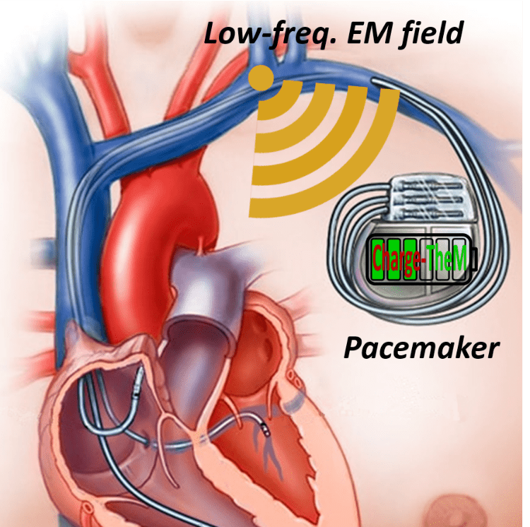 pacemaker